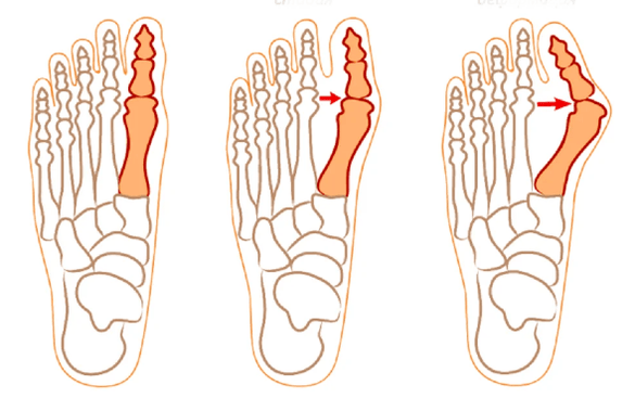 Hallux-valgus-Deformität