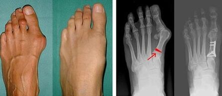 Hallux-valgus-Symptome