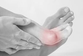 Hallux valgus, wie man Schuhe auswählt