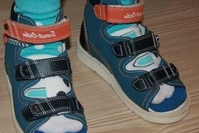 Tragen von Sandalen bei Hallux valgus bei einem Kind