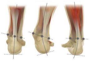 Normaler Fuß mit Abweichung des Fersenbeins in Valgus und Varus