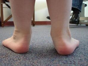 Plattfuß-Valgus-Deformität bei einem Kind
