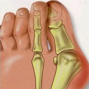 Valgus 'Gründe